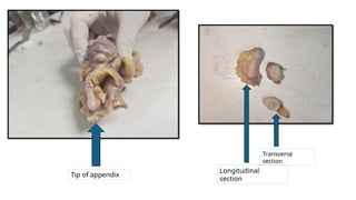 APPENDIX SLIDE – BENIGN ^0 MALIGNANT.pptx