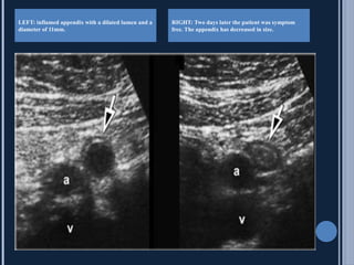Appendix ultrasound for diagnostic purposes | PPTX
