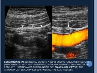 Appendix ultrasound for diagnostic purposes | PPTX