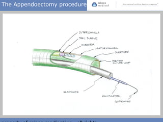 The Appendoectomy procedure
 