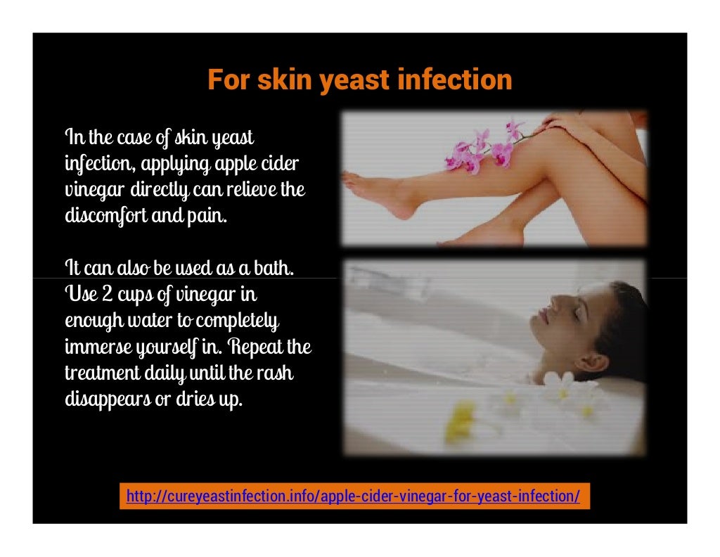 Apple cider vinegar for yeast infection