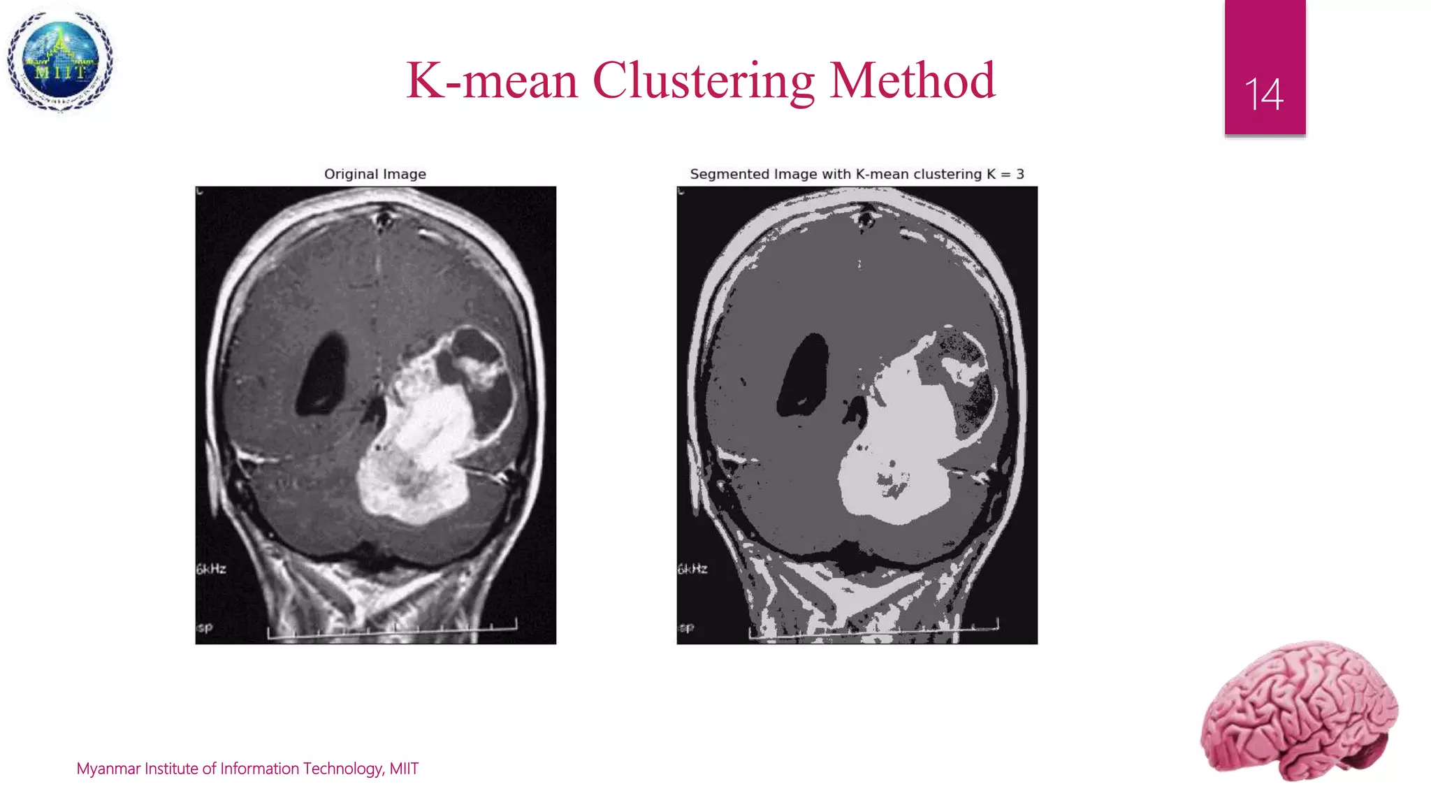 Application of-image-segmentation-in-brain-tumor-detection | PPTX ...