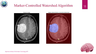 Myanmar Institute of Information Technology, MIIT
18Marker-Controlled Watershed Algorithm
 