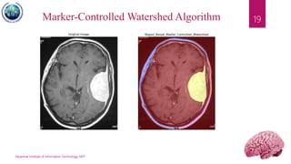 Myanmar Institute of Information Technology, MIIT
19Marker-Controlled Watershed Algorithm
 