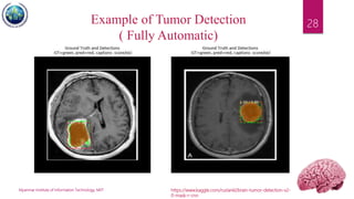 Myanmar Institute of Information Technology, MIIT
28Example of Tumor Detection
( Fully Automatic)
https://www.kaggle.com/ruslankl/brain-tumor-detection-v2-
0-mask-r-cnn
 