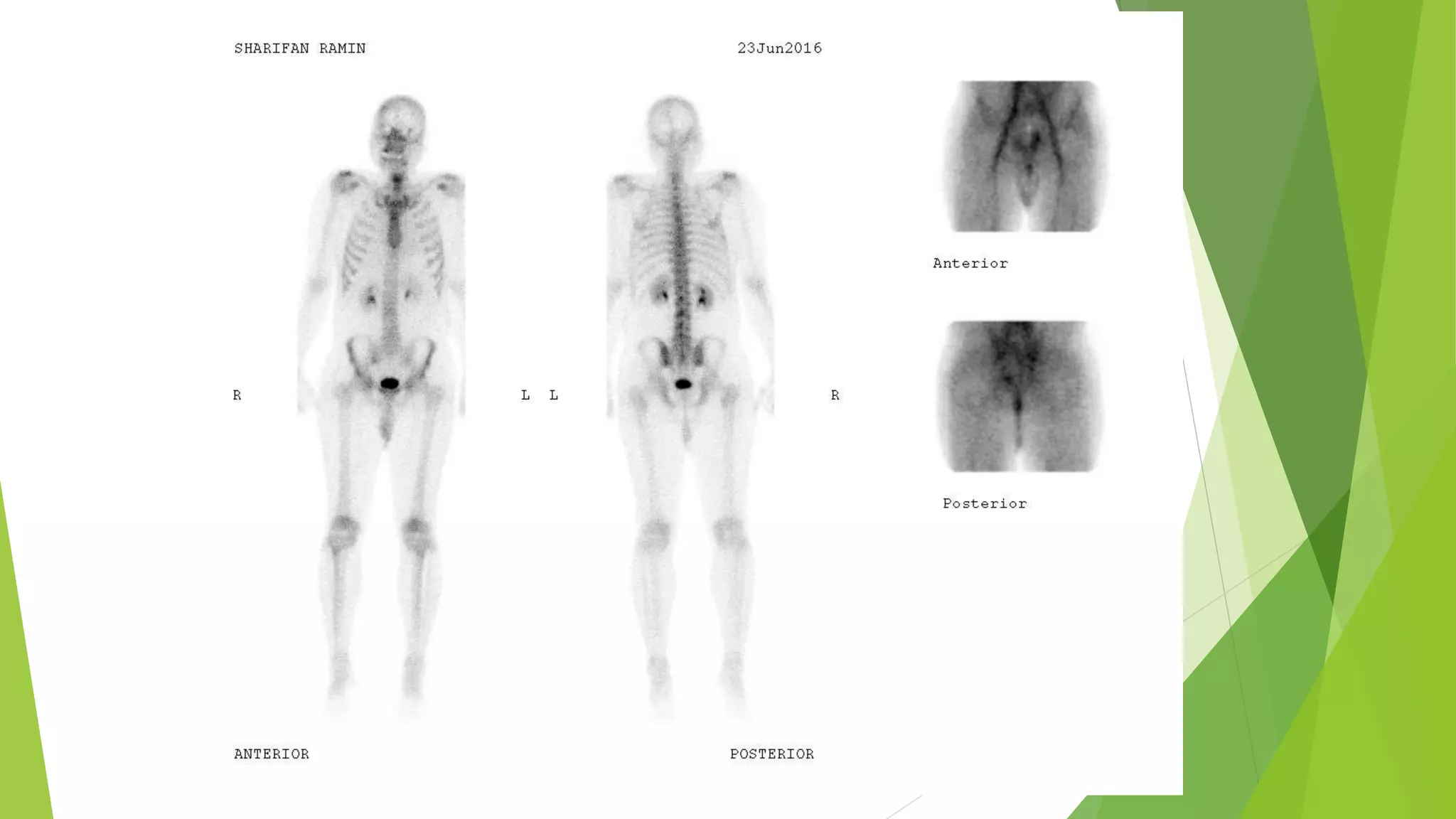 Application of bone scan in primary bone tumors | PPTX | Bone and Joint ...