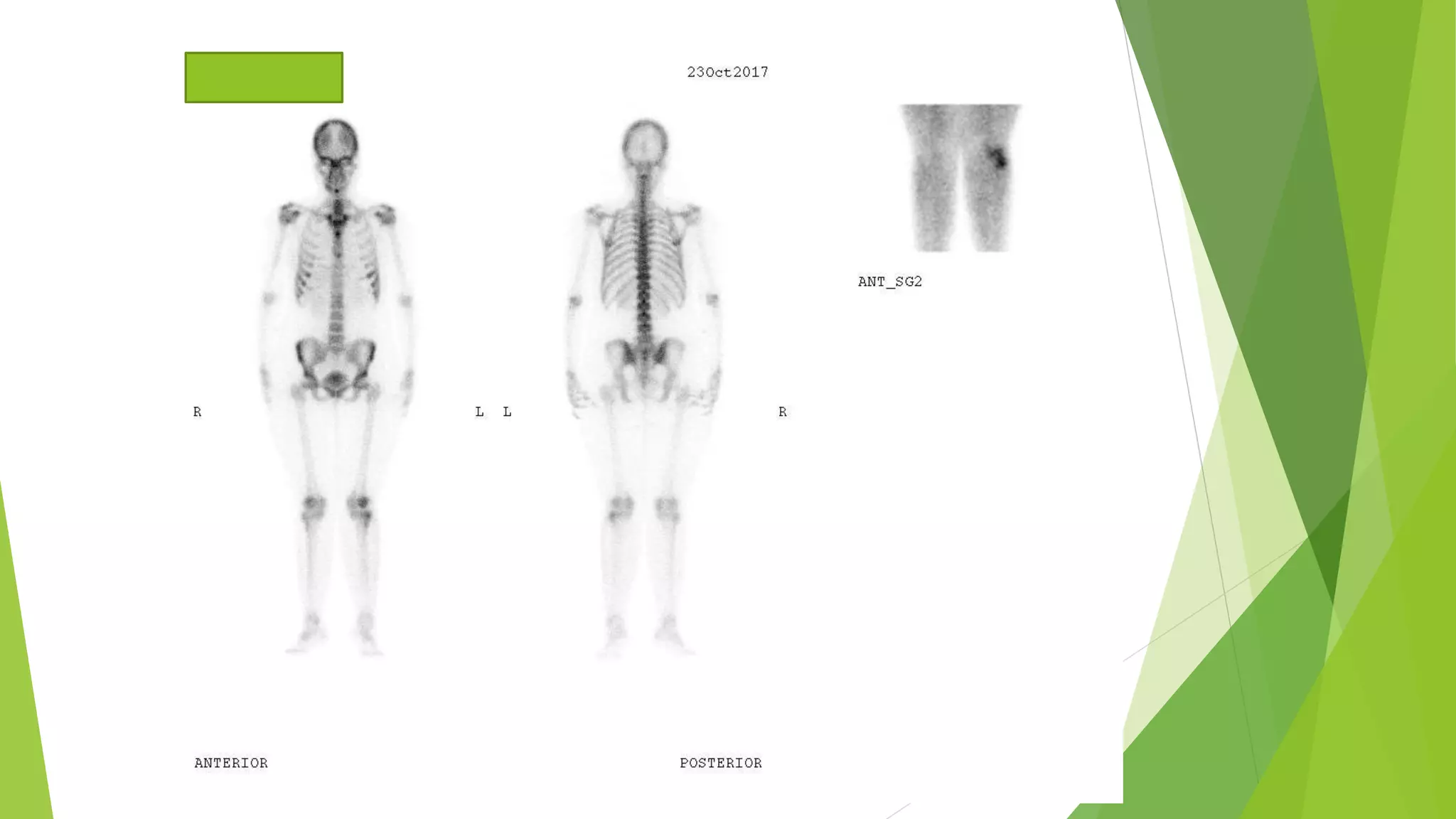 Application of bone scan in primary bone tumors | PPTX | Bone and Joint ...