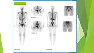 Application of bone scan in primary bone tumors | PPTX