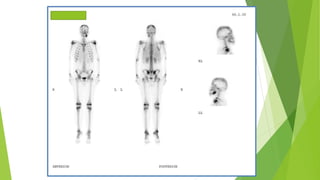 Application of bone scan in primary bone tumors | PPTX