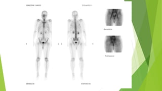 Application of bone scan in primary bone tumors | PPTX