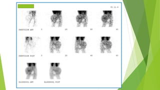 Application of bone scan in primary bone tumors | PPTX