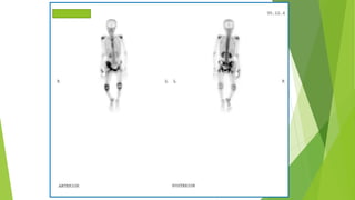 Application of bone scan in primary bone tumors | PPTX