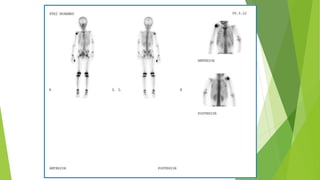 Application of bone scan in primary bone tumors | PPTX