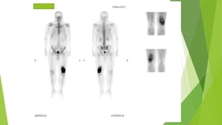 Application of bone scan in primary bone tumors | PPTX