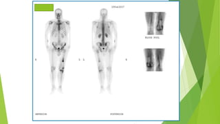 Application of bone scan in primary bone tumors | PPTX