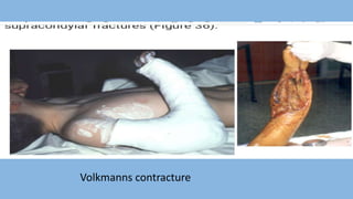 Volkmanns contracture
 