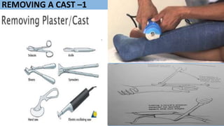 REMOVING A CAST –1
 