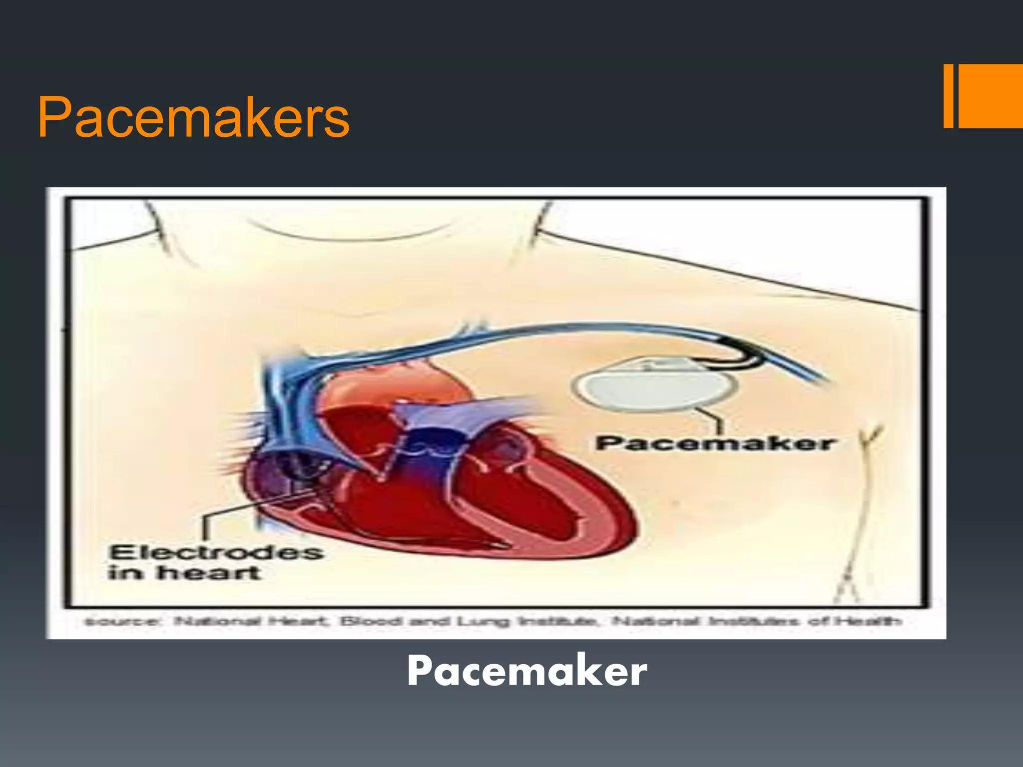 Pacemakers
Pacemaker
 