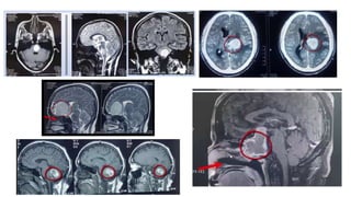 Application of Neuronavigation in Brain Surgery | PPTX
