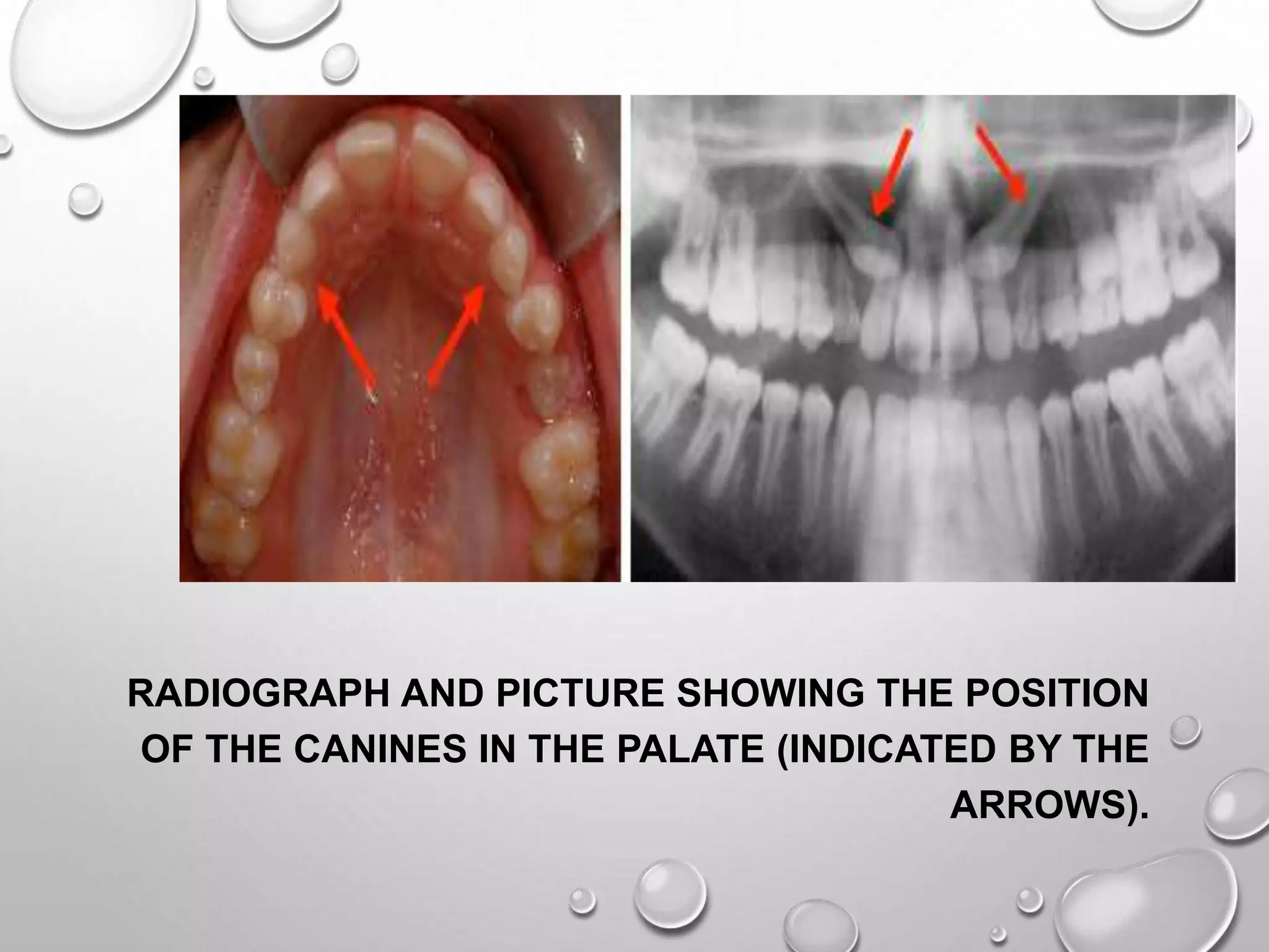 RADIOGRAPH AND PICTURE SHOWING THE POSITION
OF THE CANINES IN THE PALATE (INDICATED BY THE
ARROWS).
 