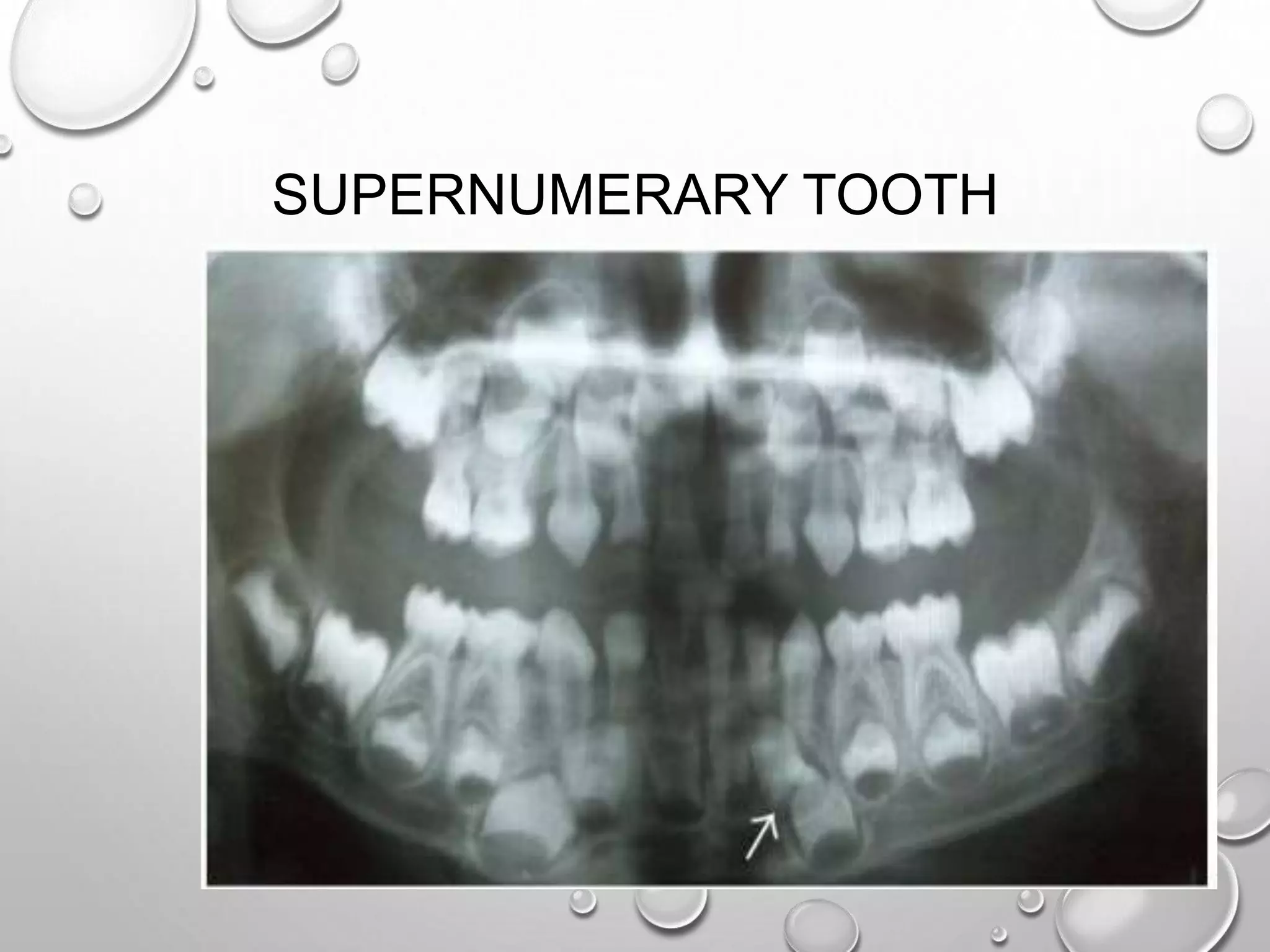 SUPERNUMERARY TOOTH
 