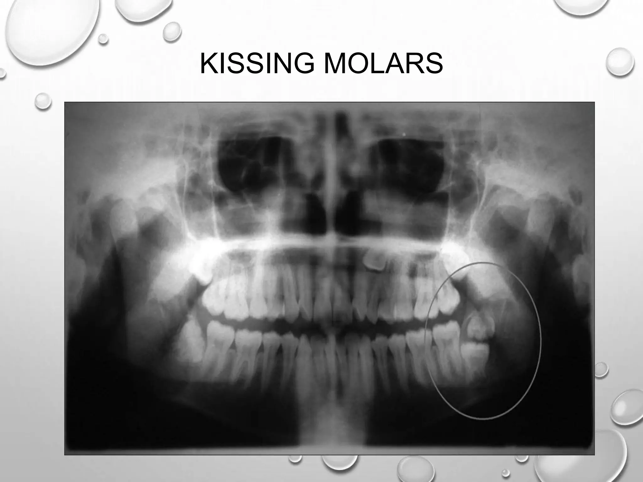 KISSING MOLARS
 