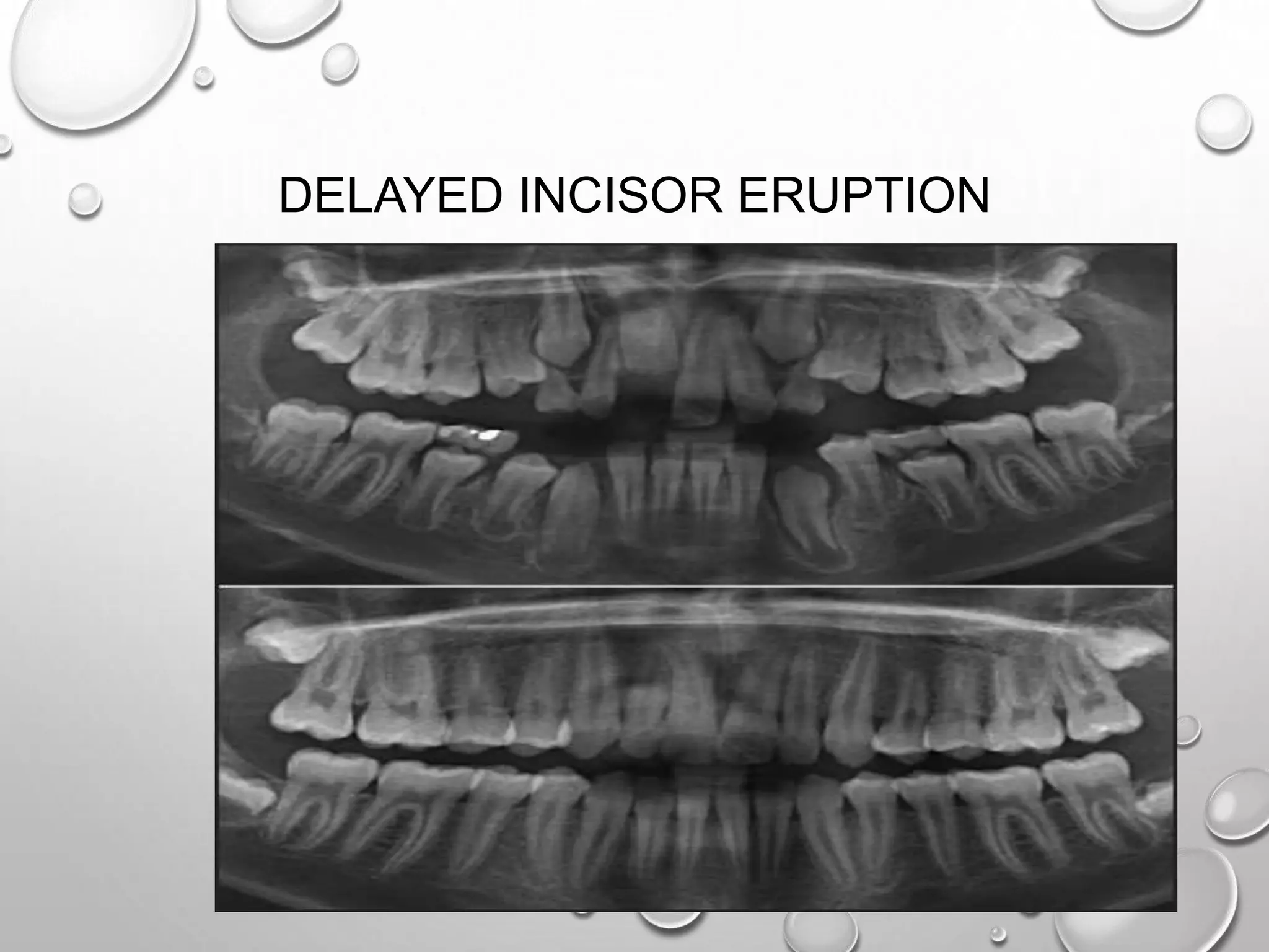 DELAYED INCISOR ERUPTION
 