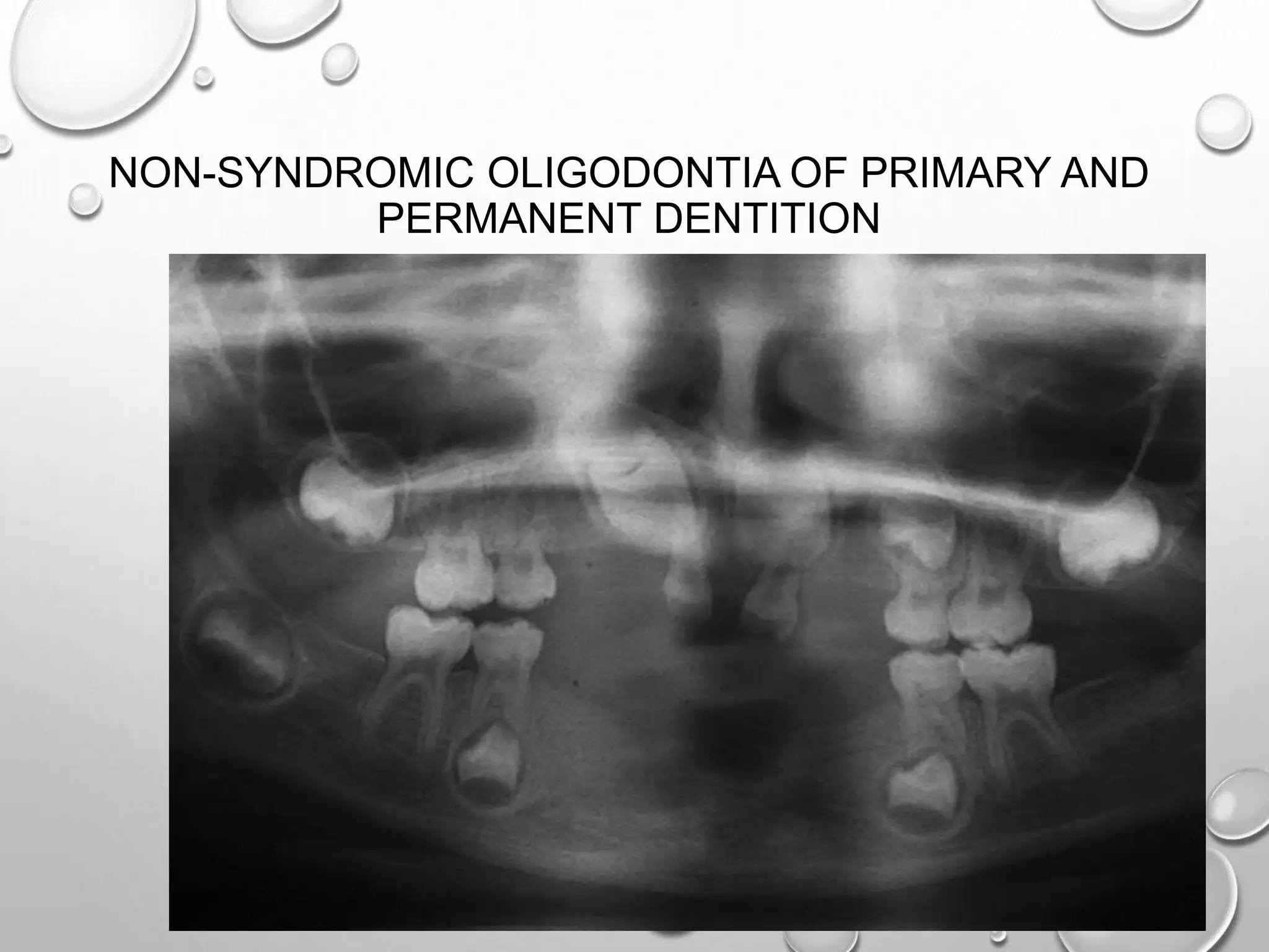 NON-SYNDROMIC OLIGODONTIA OF PRIMARY AND
PERMANENT DENTITION
 