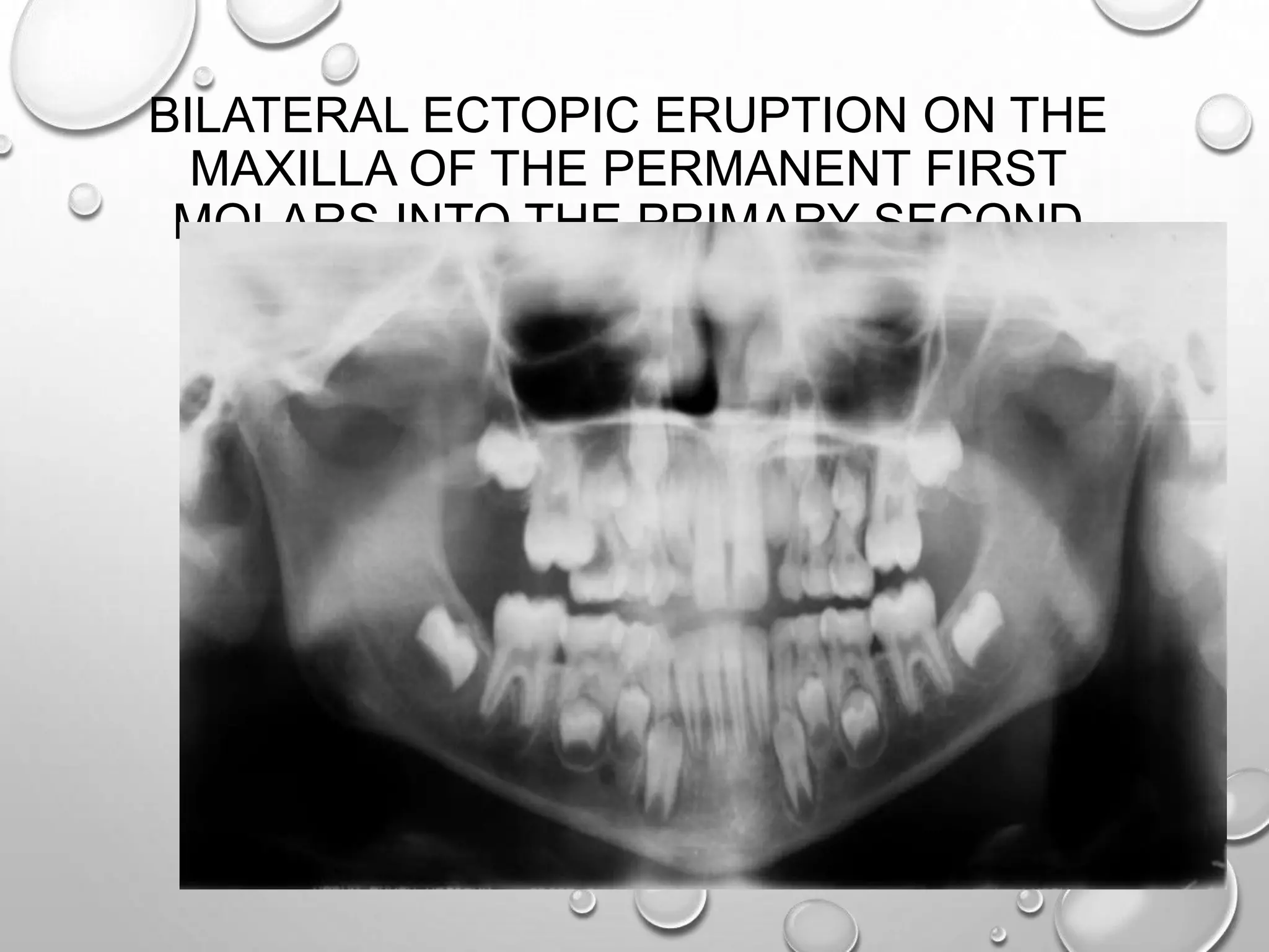 BILATERAL ECTOPIC ERUPTION ON THE
MAXILLA OF THE PERMANENT FIRST
MOLARS INTO THE PRIMARY SECOND
MOLARS
 
