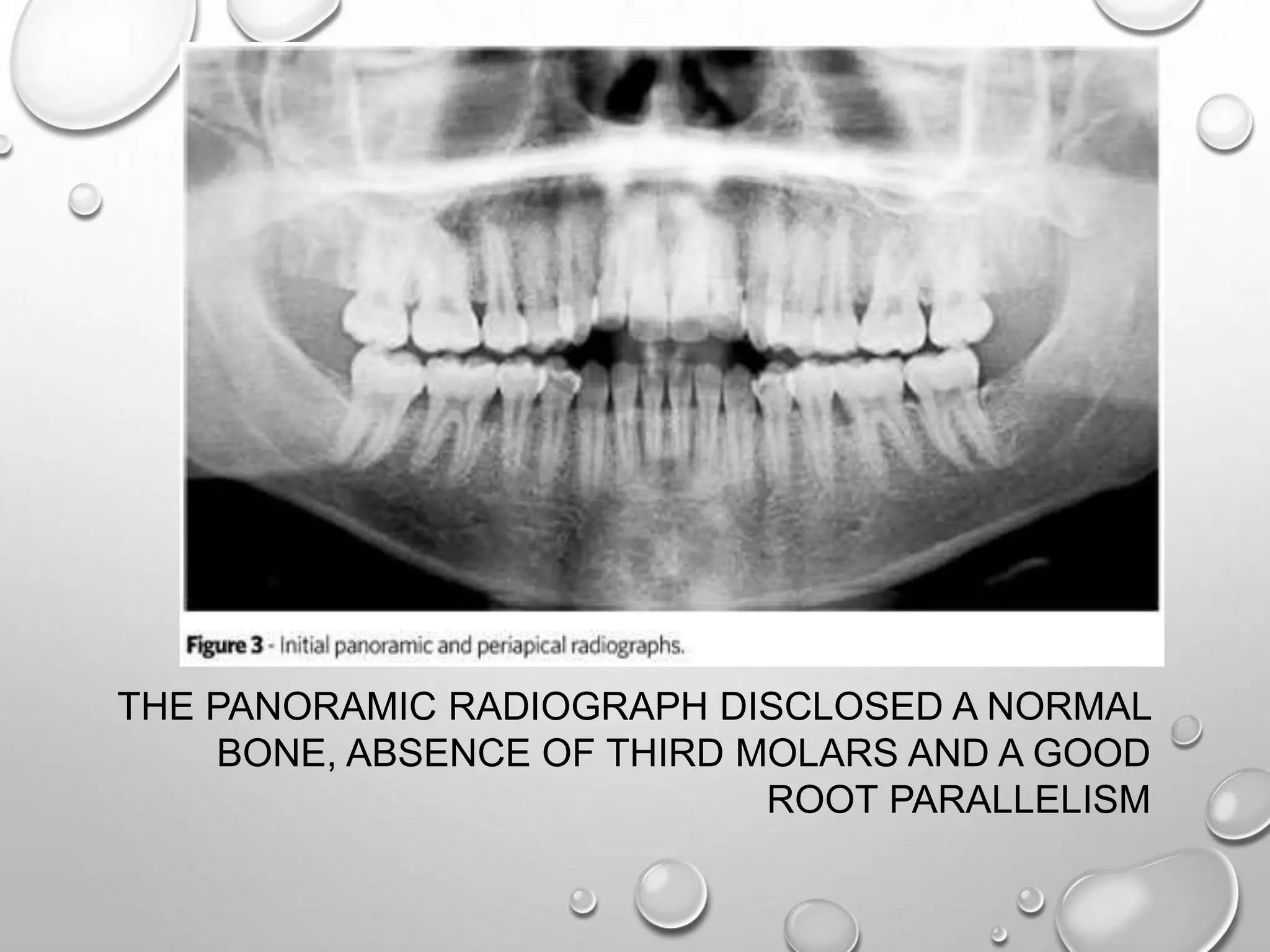 THE PANORAMIC RADIOGRAPH DISCLOSED A NORMAL
BONE, ABSENCE OF THIRD MOLARS AND A GOOD
ROOT PARALLELISM
 