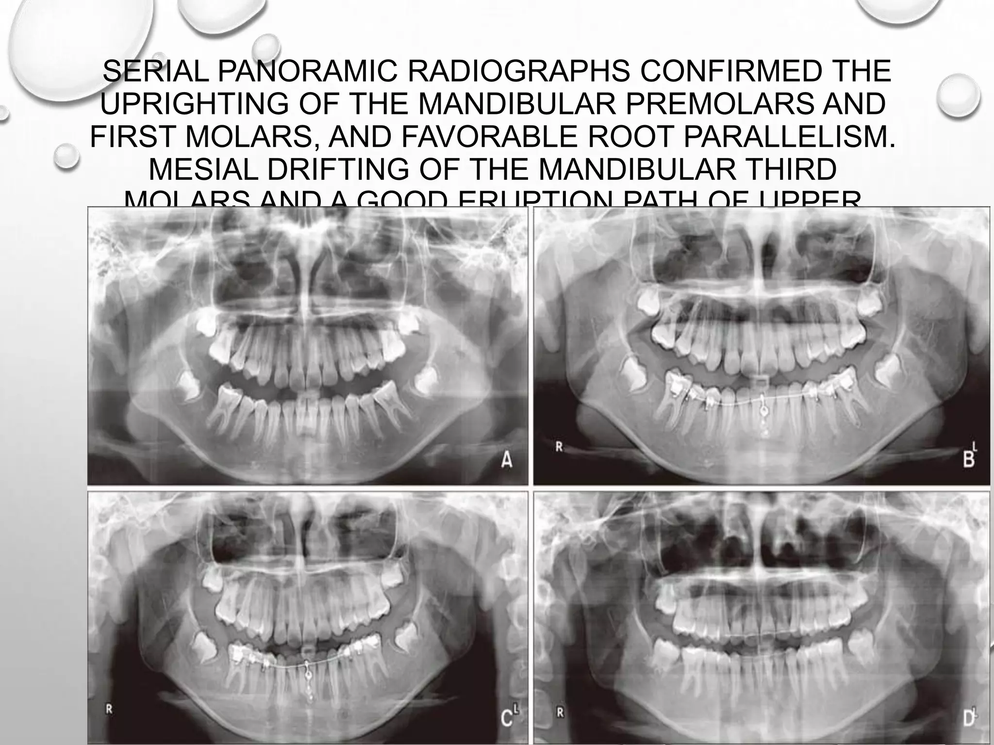 SERIAL PANORAMIC RADIOGRAPHS CONFIRMED THE
UPRIGHTING OF THE MANDIBULAR PREMOLARS AND
FIRST MOLARS, AND FAVORABLE ROOT PARALLELISM.
MESIAL DRIFTING OF THE MANDIBULAR THIRD
MOLARS AND A GOOD ERUPTION PATH OF UPPER
THIRD MOLARS
 