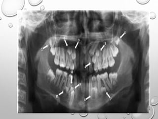 Application of opg in orthodontics | PPTX
