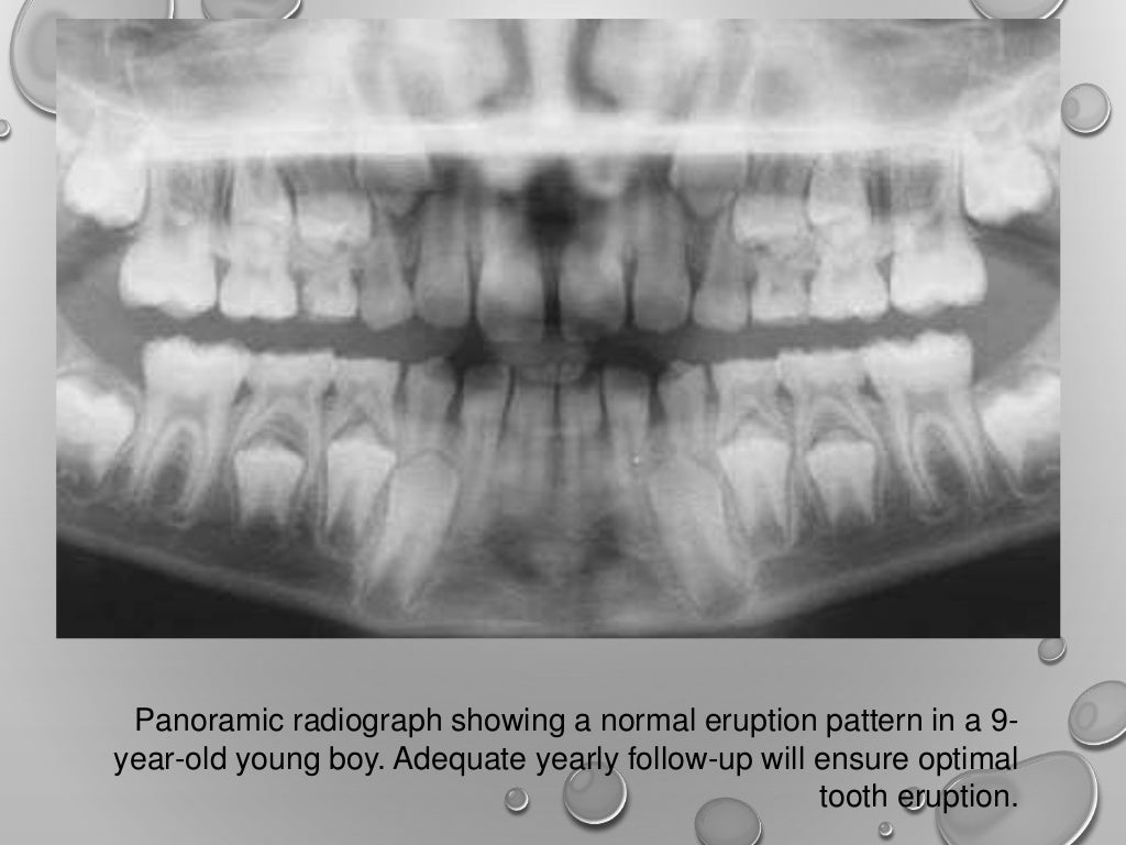 Application of opg in orthodontics