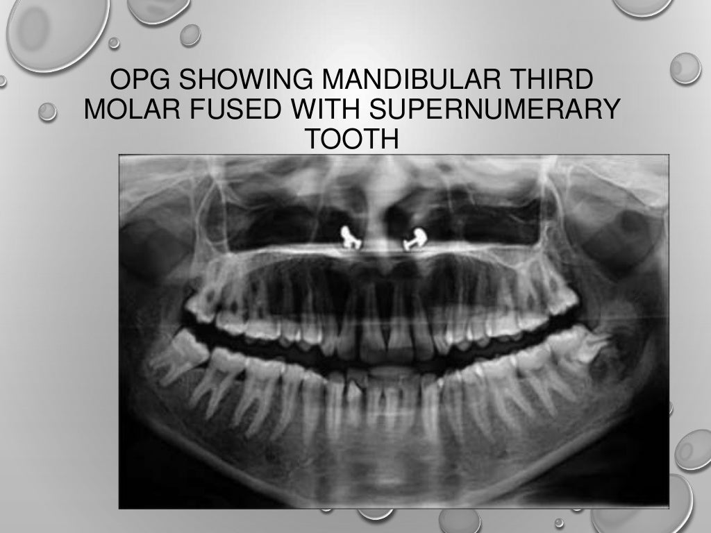 Application of opg in orthodontics