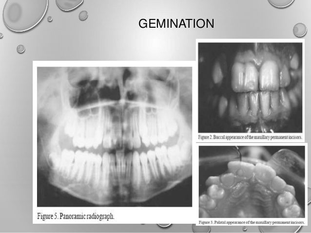 bilateral fusion of mandibular second molars Braz dent j (2002) 13(2): 137-141 bilateral fusion of mandibular second molars with supernumerary teeth: case report eduardo nunes1 ivaldo gomes. bilateral fusion of mandibular second molars Braz dent j (2002) 13(2): 137-141 bilateral fusion of mandibular second molars with supernumerary teeth: case report eduardo nunes1 ivaldo gomes.