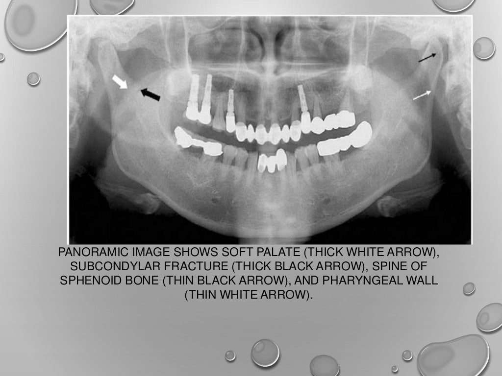 Application of opg in orthodontics
