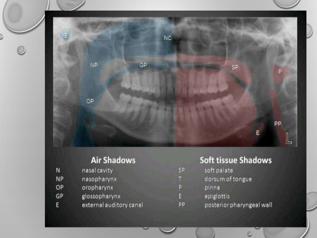 Application of opg in orthodontics