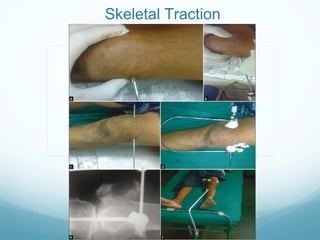 Application of traction in orthopaedics | PPT