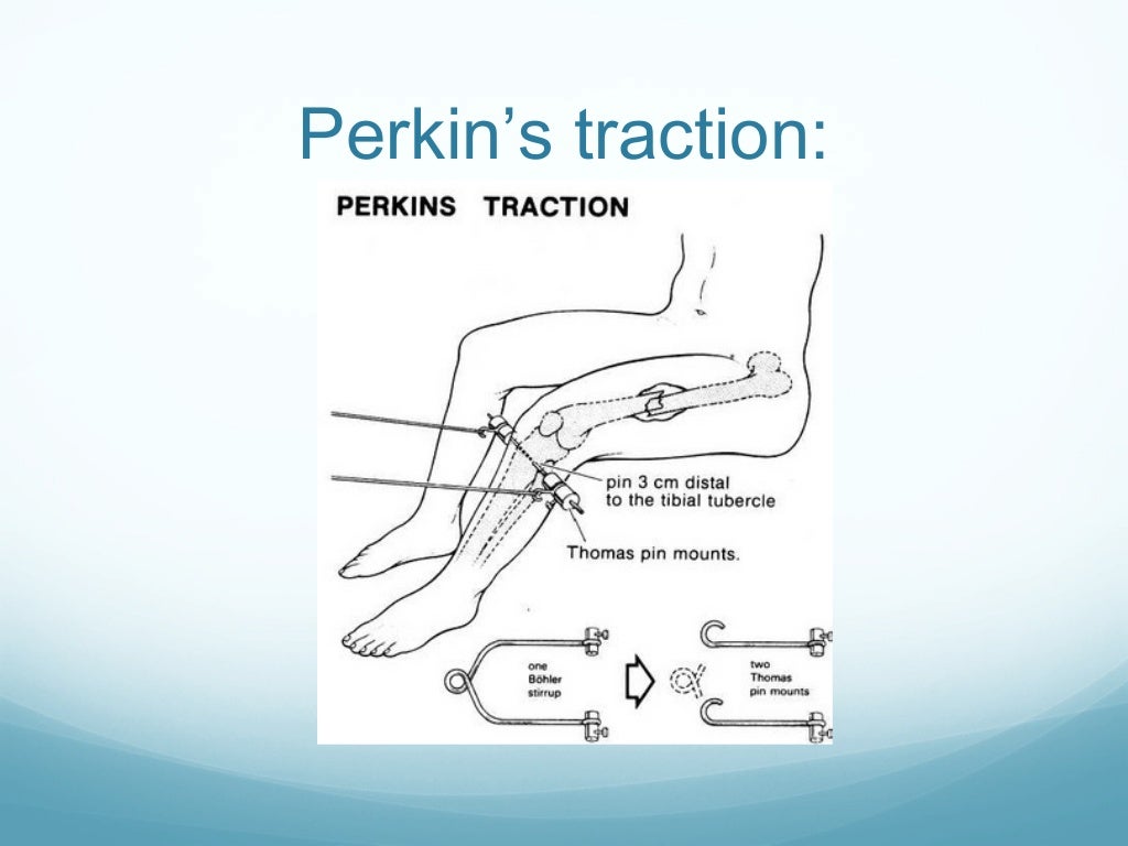 Application of traction in orthopaedics