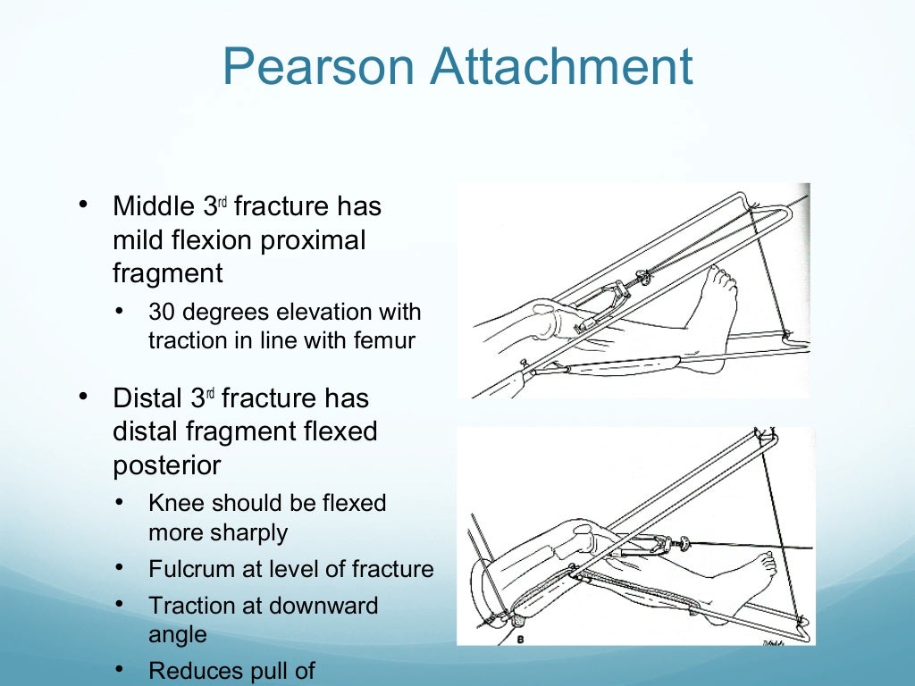 Application of traction in orthopaedics