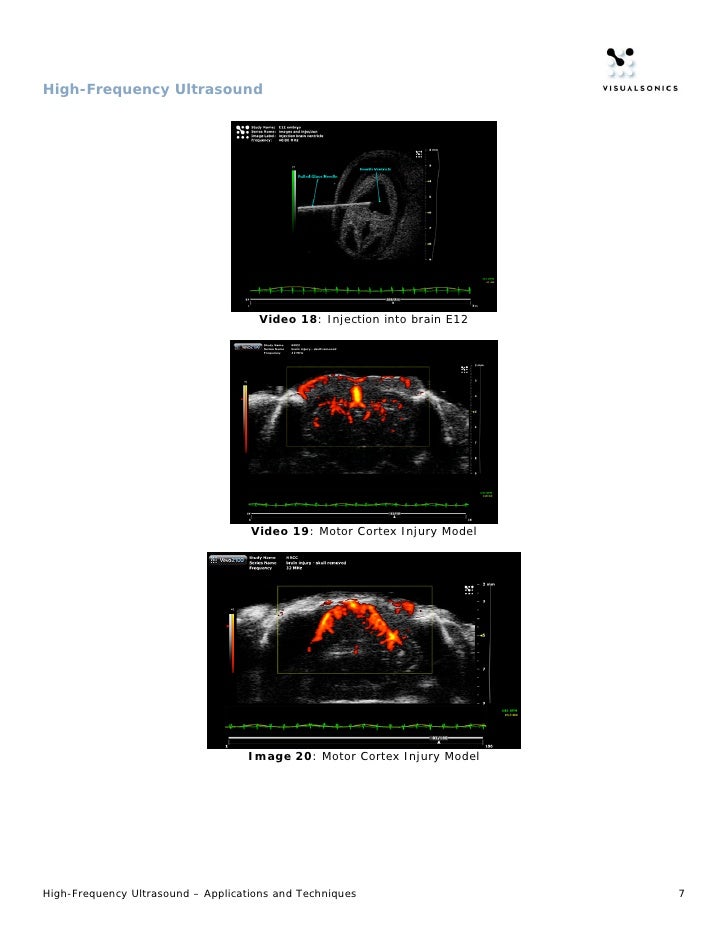 HighFrequency Ultrasound Application Features & Benefits