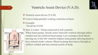 Ventricle Assist Device (V.A.D). 
 Ventricle assist device (V.A.D) 
 Used to help partially working ventricles of heart 
 Example: 
NovaCare LVAS 
 How it works: Pump connected to left ventricle. 
When heart pumps, bloods enters from left ventricle through inflow 
conduit and into artificial heart pump. Low resistance from blood 
moving out of the left ventricle reduces load greatly allowing heart to 
have normal stroke volume. Blood in pump then leaves through an 
outflow conduit and into arterial system of body. 
5 
 