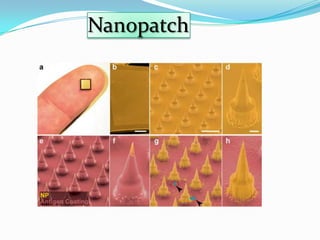 Nanopatch
 