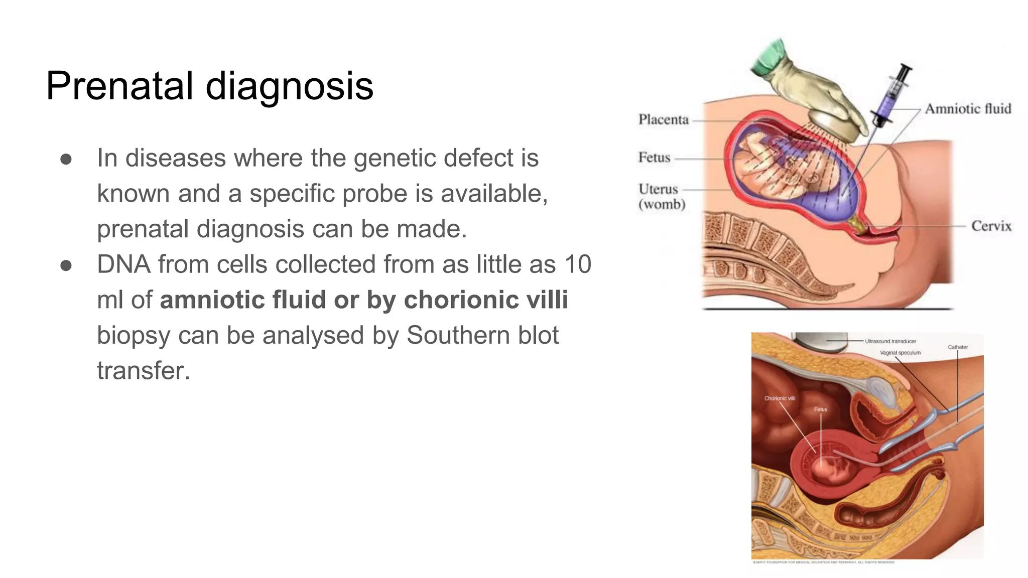 Prenatal diagnosis
● In diseases where the genetic defect is
known and a specific probe is available,
prenatal diagnosis can be made.
● DNA from cells collected from as little as 10
ml of amniotic fluid or by chorionic villi
biopsy can be analysed by Southern blot
transfer.
 