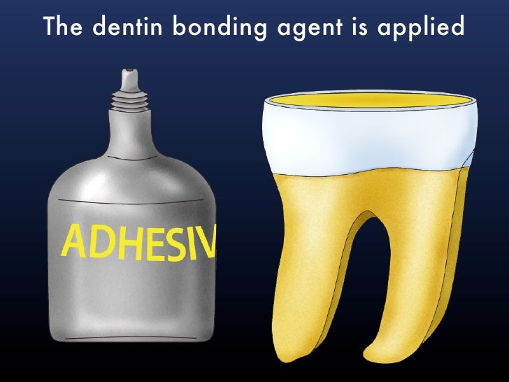 Application technique for Dentin bonding agents