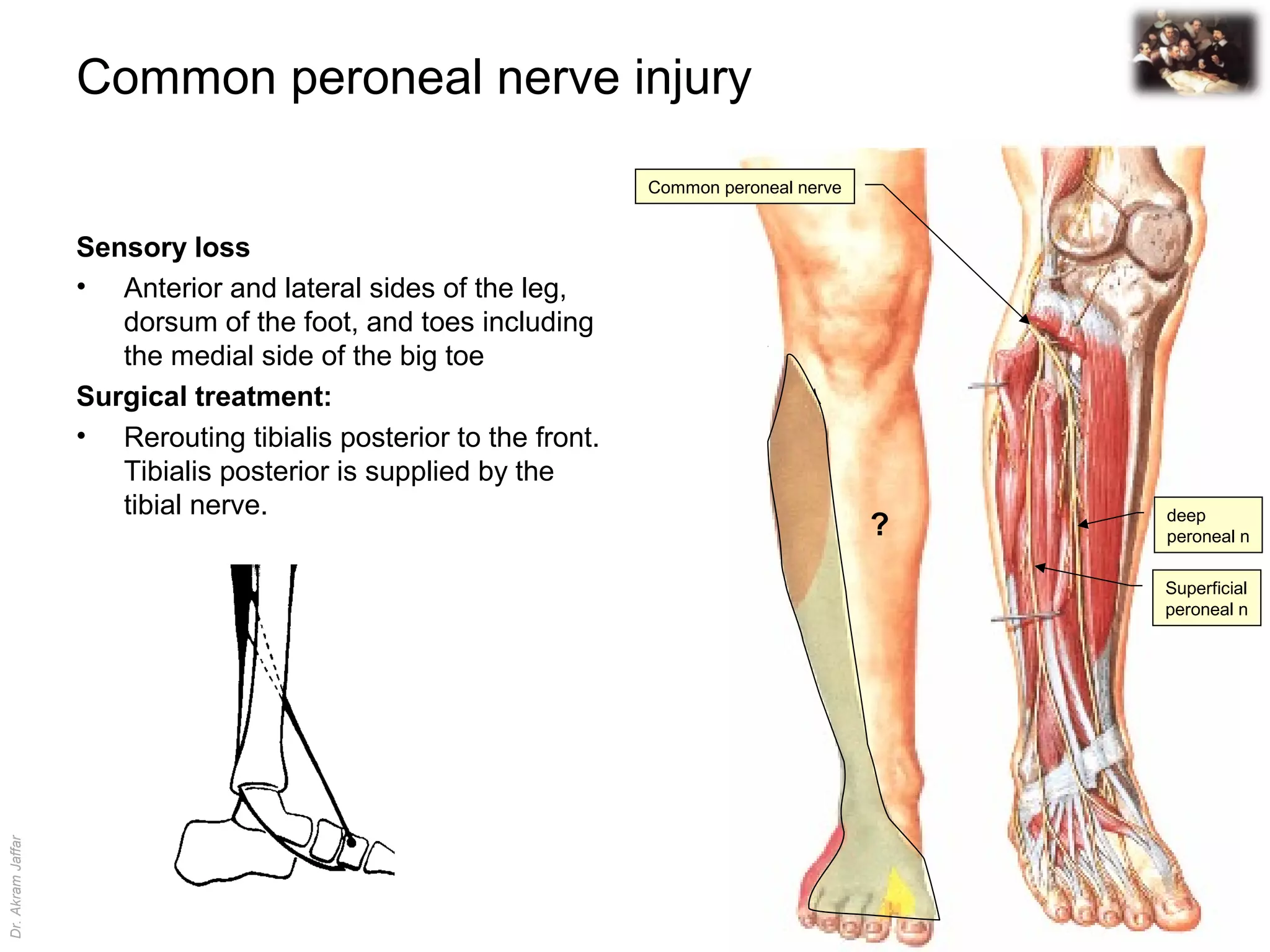 Applied Anatomy Common Peroneal Nerve Injury PPT Applied Anatomy Common Peroneal Nerve Injury PPT