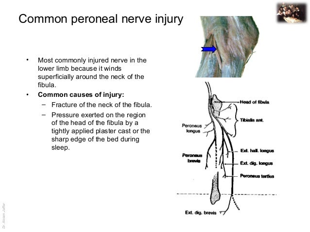 Applied anatomy common peroneal nerve injury