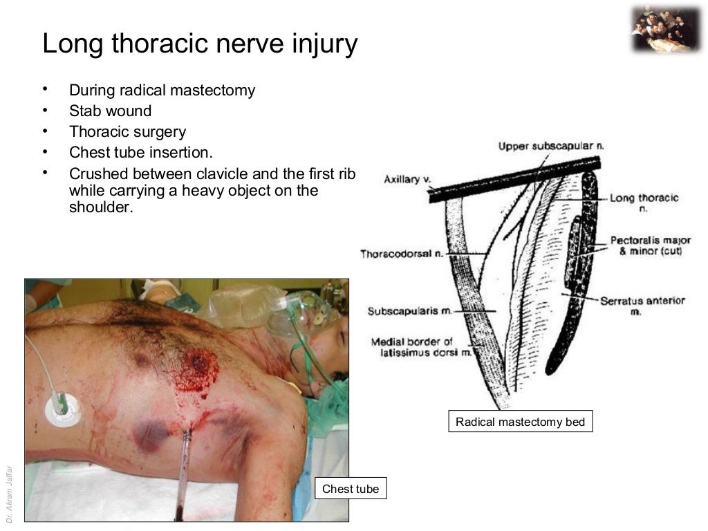 Applied anatomy long thoracic nerve injury
