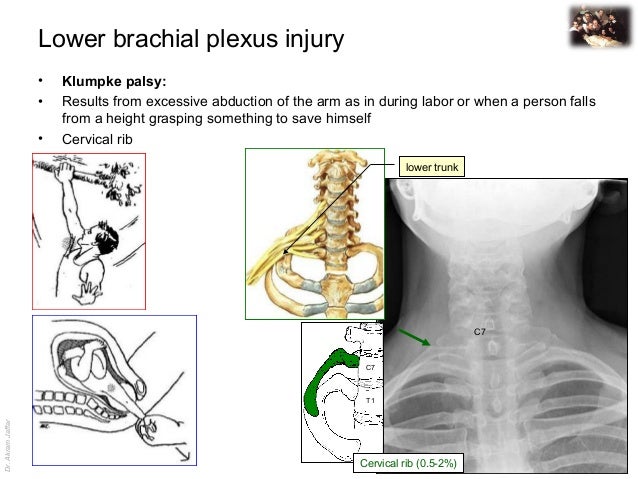 Applied anatomy lower brachial pleuxs injury