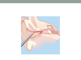 Docking Ear Process Applied Anatomy and physiology of Ear.pptx